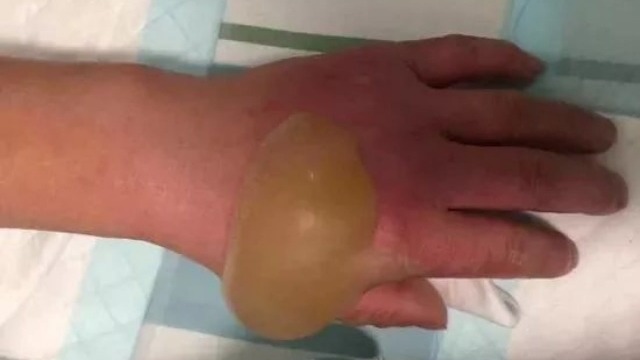 內地發生發光氣球爆炸事件，醫院診斷指病患面部及四肢都達到2度燒傷，手上出現大水泡。（網上圖片）