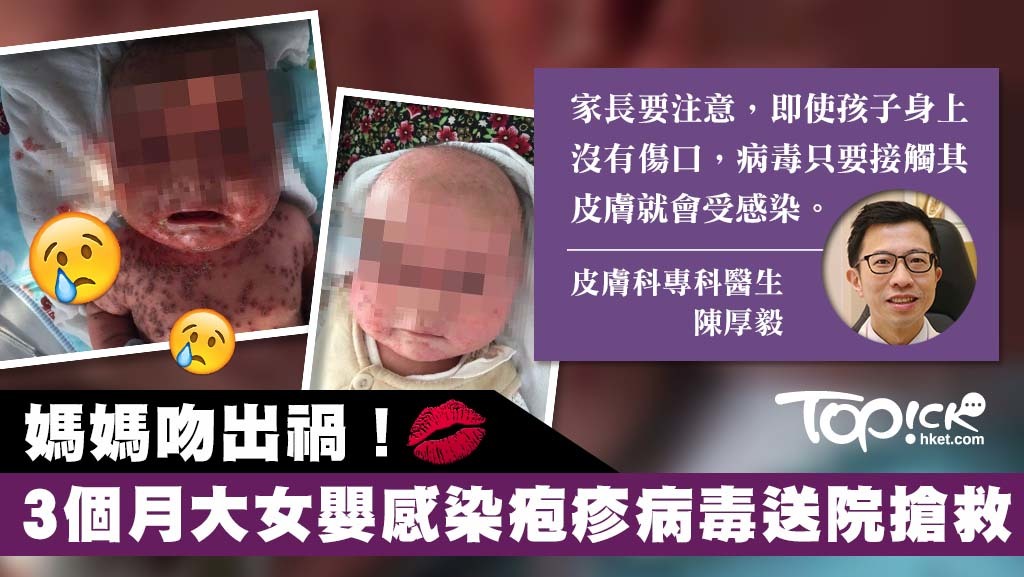 家長若患唇瘡，僅記勿親吻孩子。