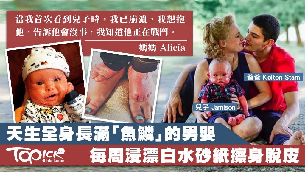 男嬰天生長滿 魚鱗 媽媽每天砂紙擦皮膚 兒子在戰鬥 香港經濟日報 Topick 親子 親子資訊 D