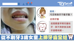 女童口腔上排全是蛀牙，醫生認為應屬於嚴重早期兒童蛀牙。