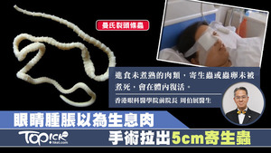 一名婦女眼睛腫脹，手術後發現內藏5cm寄生蟲。醫生指，進食未煮熟的肉類有機會引寄生蟲進入體內。