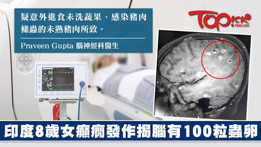 印度女童一直被受頭痛和癲癇困擾，照腦掃描才發現腦內有上百垃蟲卵。