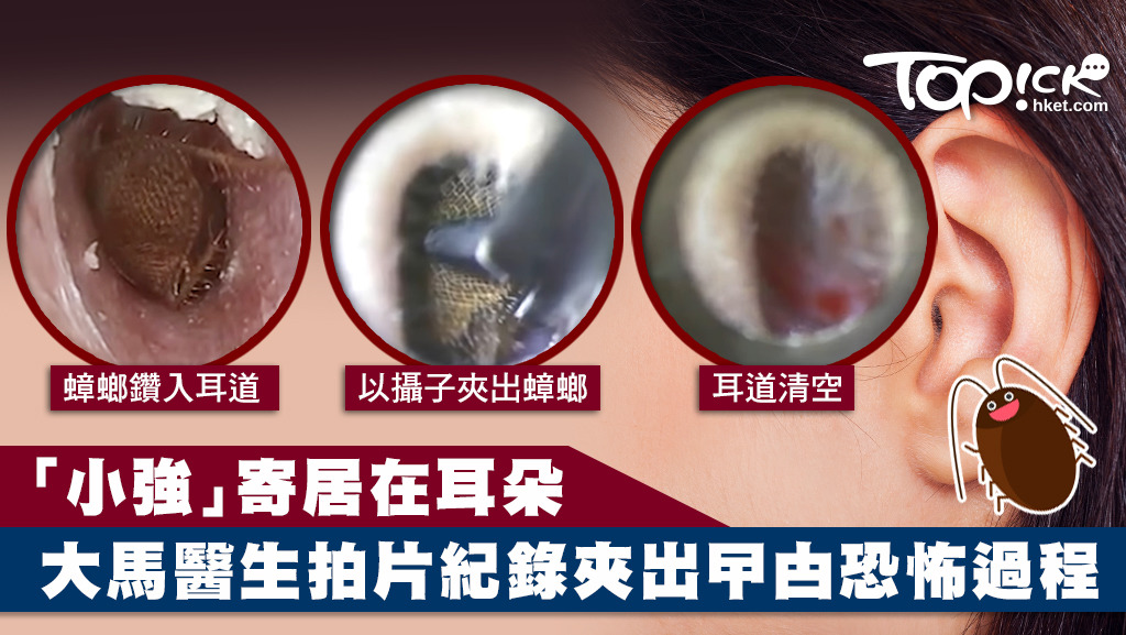 醫生拍攝夾出蟑螂的過程。