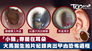 醫生拍攝夾出蟑螂的過程。