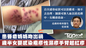 女嬰被患唇瘡媽媽親吻，感染疱疹性濕疹。