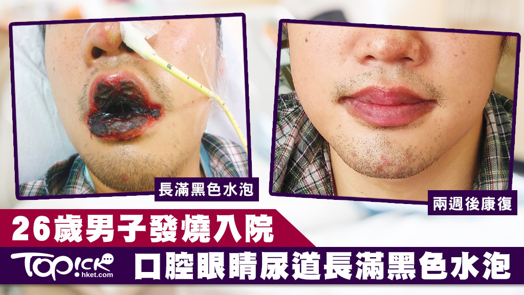黏膜炎導致病人難以進食，經過兩週抗生素治療後終康復。