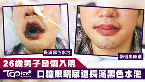 黏膜炎導致病人難以進食，經過兩週抗生素治療後終康復。
