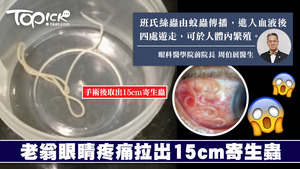 印度老翁眼睛疼痛求醫，醫生從他眼中拉出15cm寄生蟲。