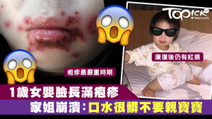 1歲女被大人口水裡的病毒傳染而染上疱疹。
