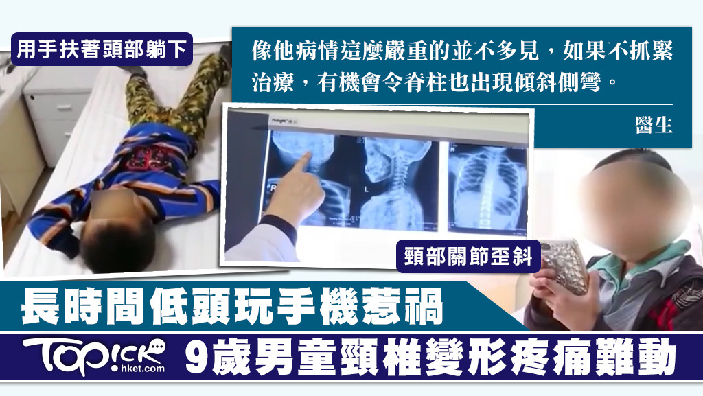 男童因長期玩手機致頸椎變形。