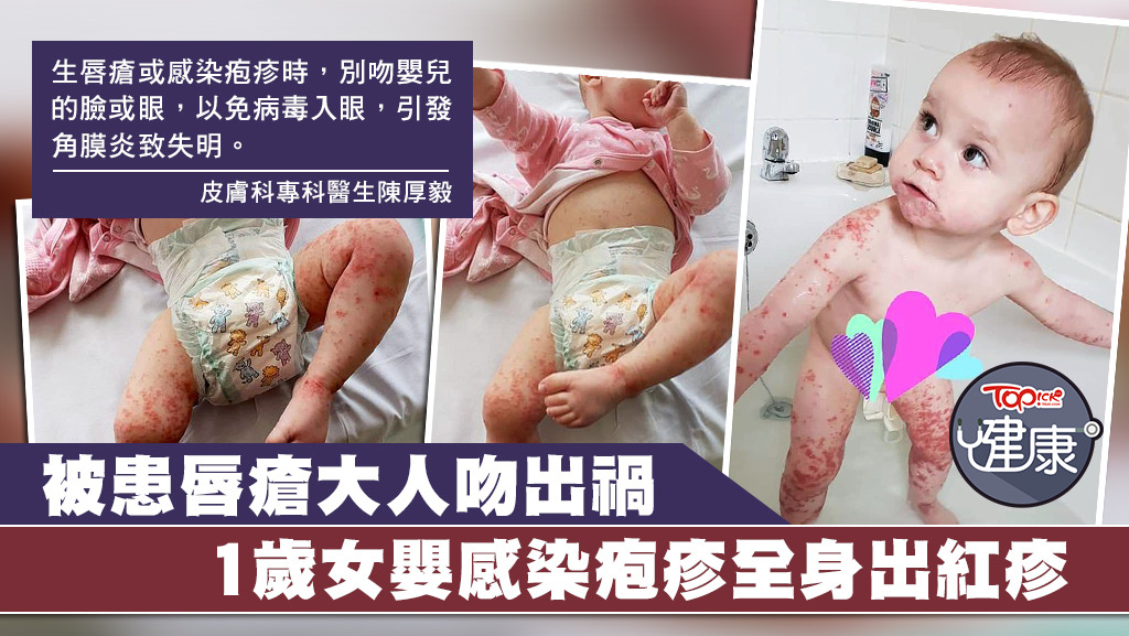 英國1歲女嬰疑被患唇瘡的大人親吻後，全身感染皰疹。