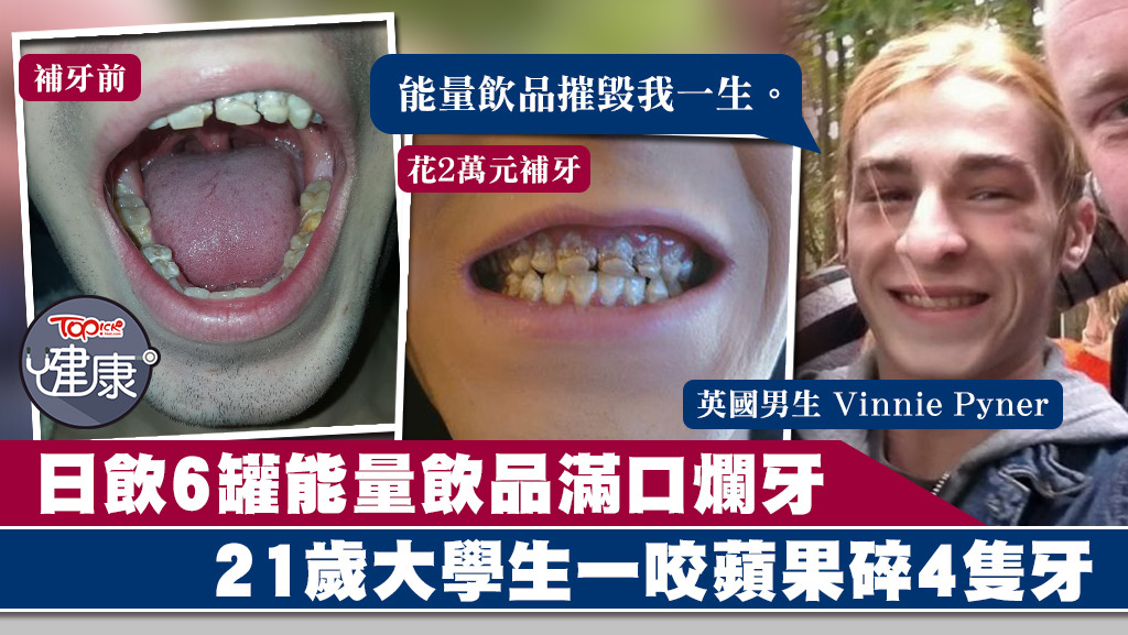 21歲大學生每日飲6罐能量飲品致滿口爛牙。