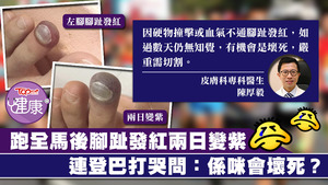 有連登巴打跑全馬後，腳趾發紅且變紫。