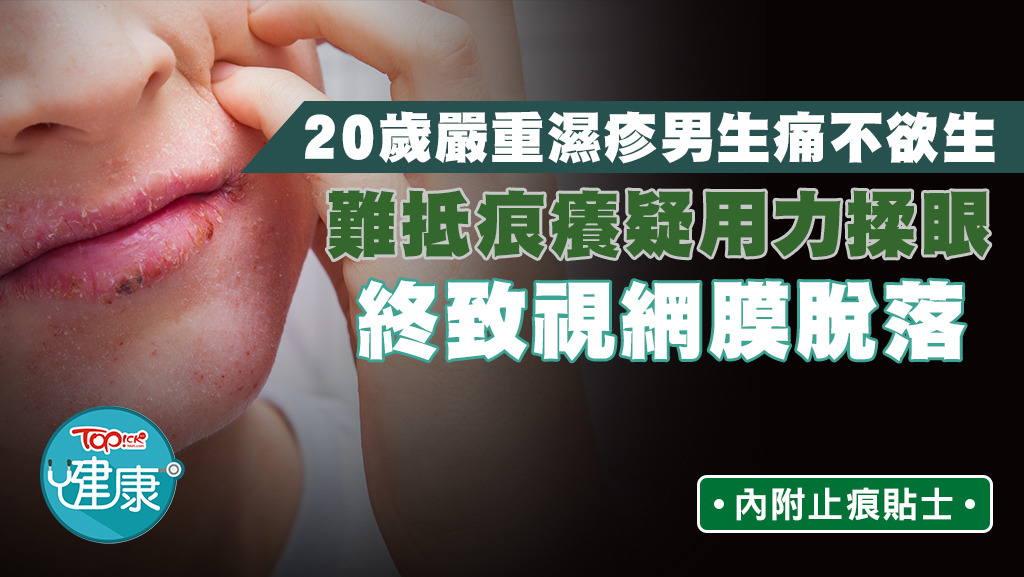 台灣一名男生患有嚴重濕疹，疑難抵痕癢，用力揉眼致視網膜脫落。