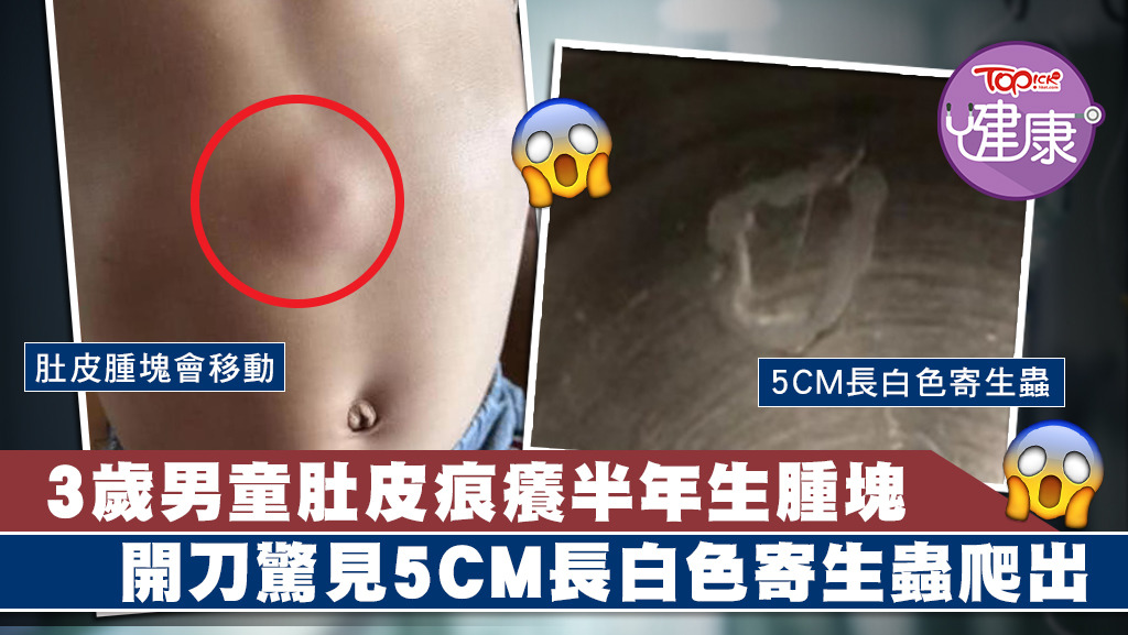 3歲男童肚皮長出腫塊，切開竟爬出寄生蟲。