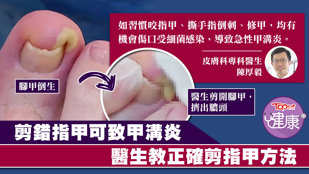 甲溝炎屬指甲與皮膚之間的位置發炎，嚴重者會紅腫熱痛，甚至有膿頭出現。