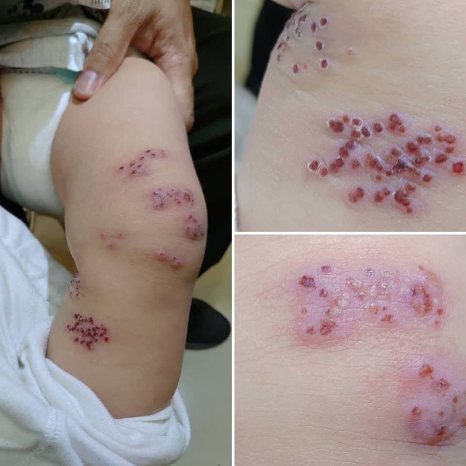 台灣醫師撰文指1歲嬰兒罕見地患上帶狀疱疹（生蛇）。（圖片來源：新竹市林祺彬皮膚科診所）