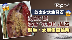 網上近期熱傳剖開腎臟滿佈猶如花生粒結石的相片。
