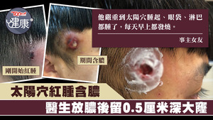 台灣一名男子日前長「疔子」，治療後太陽穴上留下目測有0.5厘米深的嚇人大洞。