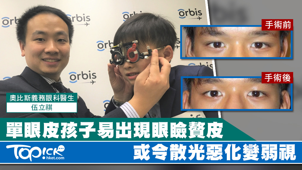 單眼皮孩子易出現眼瞼贅皮有令散光惡化變弱視- 香港經濟日報- TOPick 