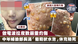 台婦做拉皮致臉部嚴重灼傷。