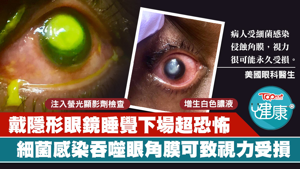 美國一名眼科醫生呼籲民眾要脫下隱形眼鏡再睡覺。