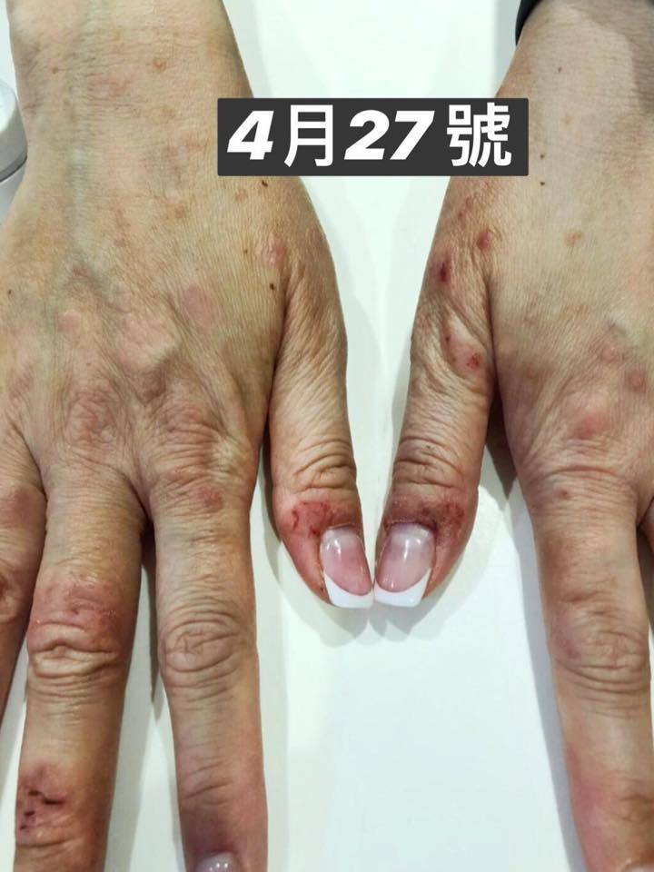在未使用蛋黃油前，雙手飽受濕疹困擾。（相片來源：劉小慧facebook）