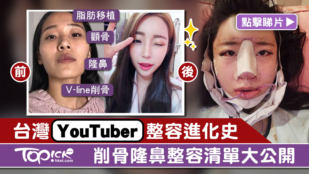台灣YouTuber赴韓削骨隆鼻整容大公開。