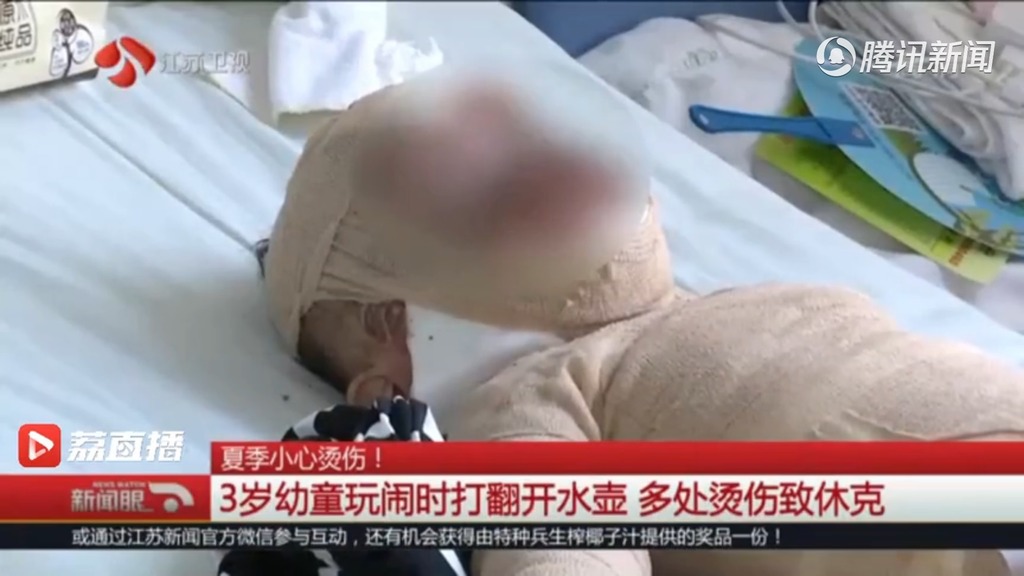 男童多處燙傷致休克。(影片截圖)