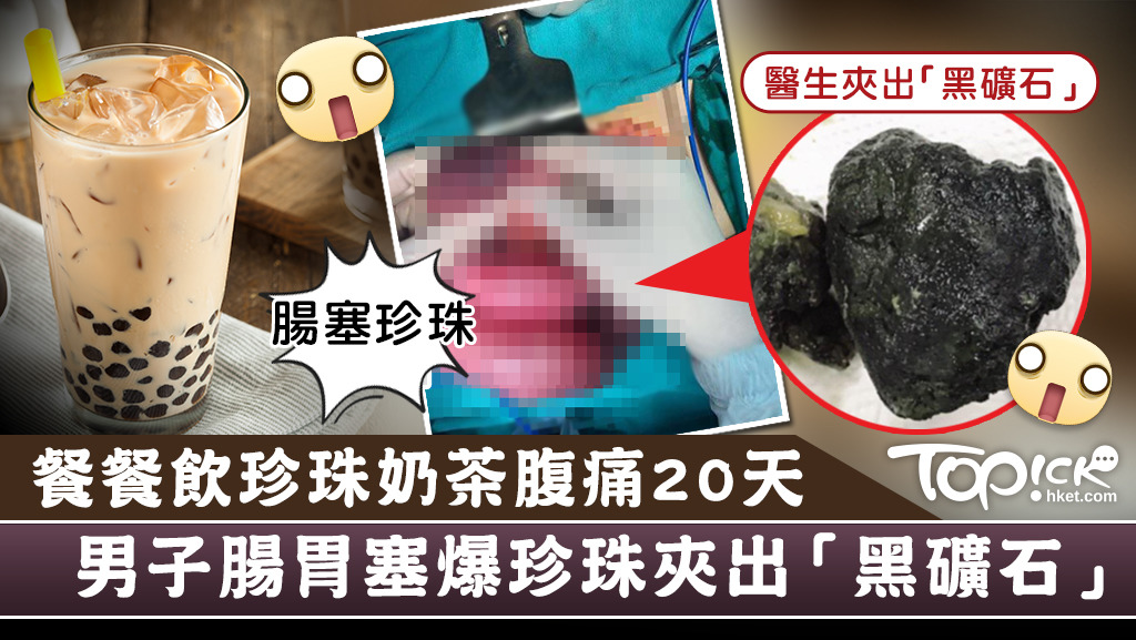 越南一名男子餐餐飲珍珠奶茶，腸胃塞爆珍珠殘渣被夾出「黑礦石」。