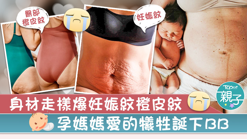 不少媽媽產後身材走樣，出現妊娠紋及橙皮紋。