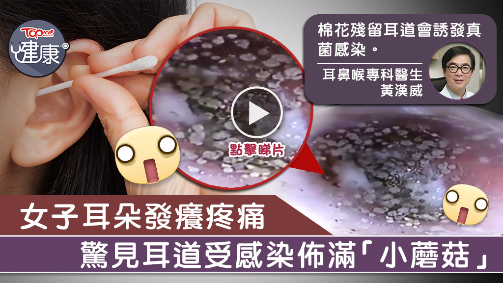 越南一名女子耳道受真菌感染，長滿數十個「黑色孢子」，如「小蘑菇」。