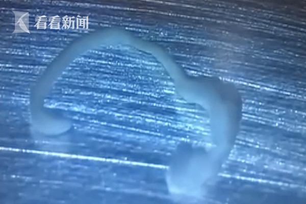 醫生在女子腦部取出活寄生蟲。（相片來源：影片截圖）