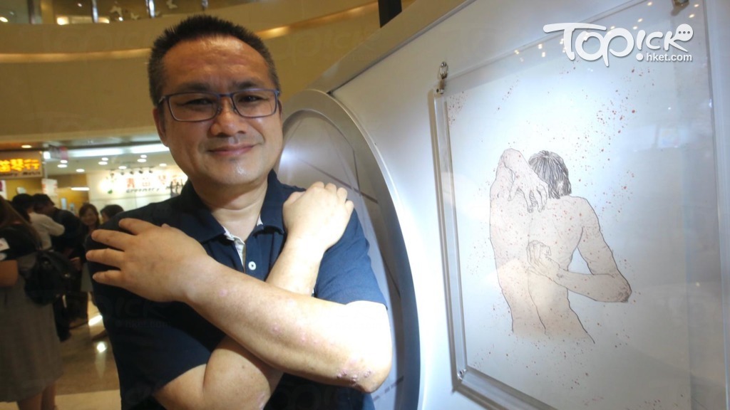 香港銀屑病友會主席黎慶坤有意讓公眾對該病症有更多了解，知道銀屑病並沒有傳染性，亦非與個人衛生問題有關。（陳靜儀攝）