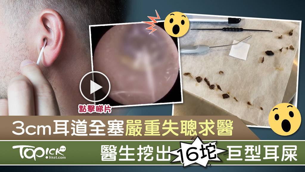 醫生於患者的雙耳挖出16坨巨型耳屎。