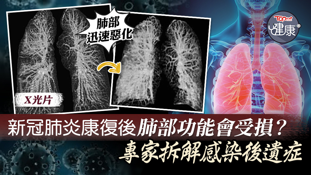 專家拆解新冠肺炎感染後遺症。
