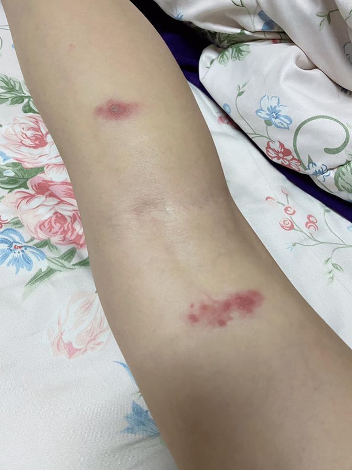 網民遭隱翅蟲咬傷。（facebook圖片）