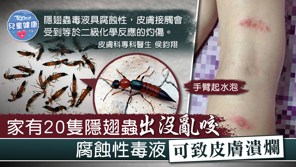 隱翅蟲毒液可致皮膚潰爛。