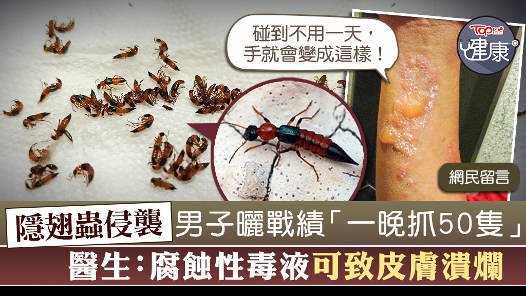 隱翅蟲來襲，有男子表示自己一晚抓了50隻。