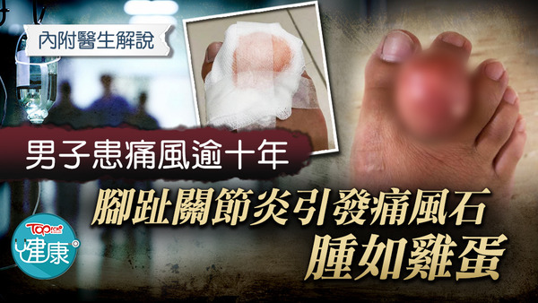 男子患痛風逾十年，腳趾關節炎引發痛風石腫如雞蛋。