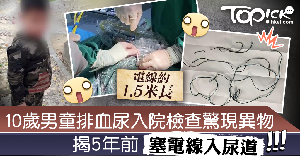 貪玩惹禍】10歲男童排血尿入院尿道嚴重感染揭5年前貪玩曾塞電線入尿道 