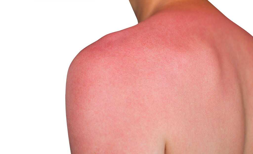 暴曬後3至6小時皮膚會變得紅腫、刺痛及發熱。（相片：iStock）