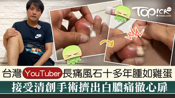台灣YouTuber長痛風石十多年腫如雞蛋，接受清創手術擠出白膿。
