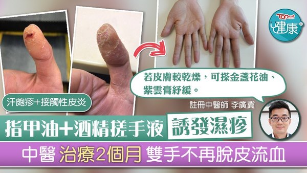 長期接觸指甲油和酒精搓手液，有機會誘發濕疹。