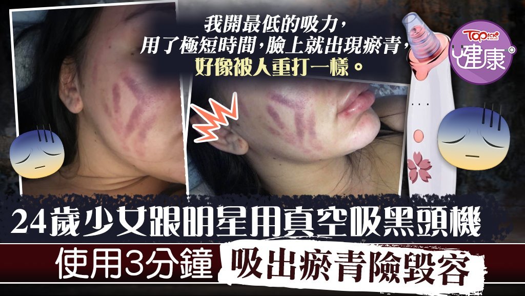 24歲少女跟明星用真空吸黑頭機，結果吸出六道瘀痕險毀容。
