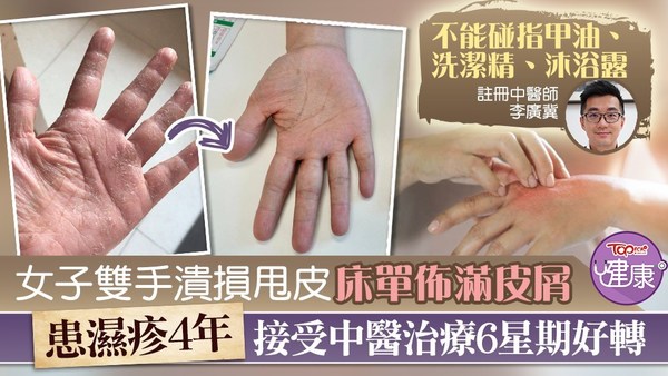 雙手有濕疹人士要避開觸碰指甲油、洗潔精、沐浴露等刺激皮膚的產品。