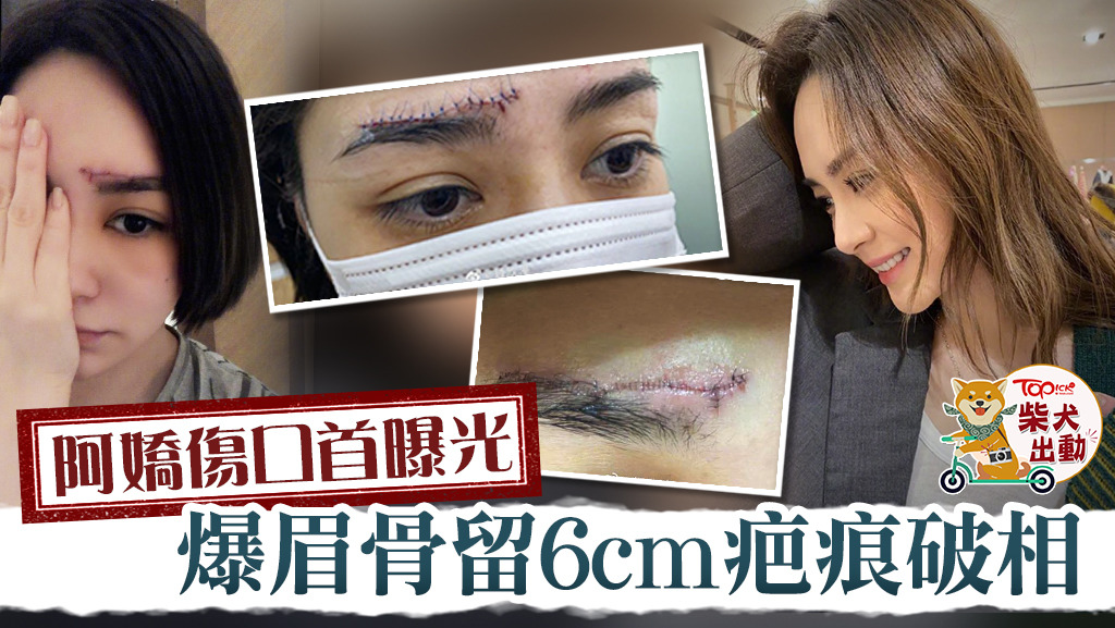 鍾欣潼爆眉骨6cm傷口曝光。