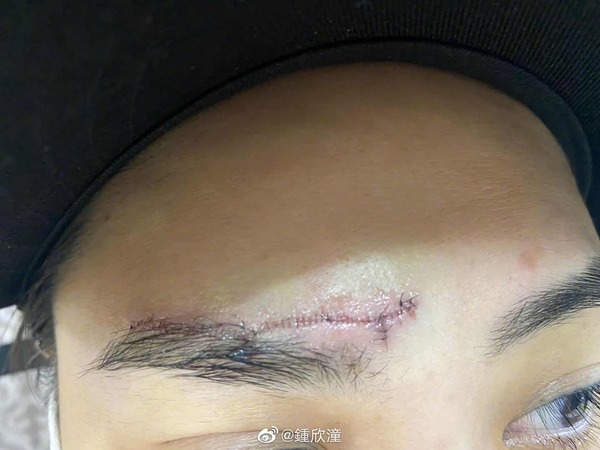 整形外科醫生再替她縫合傷口。