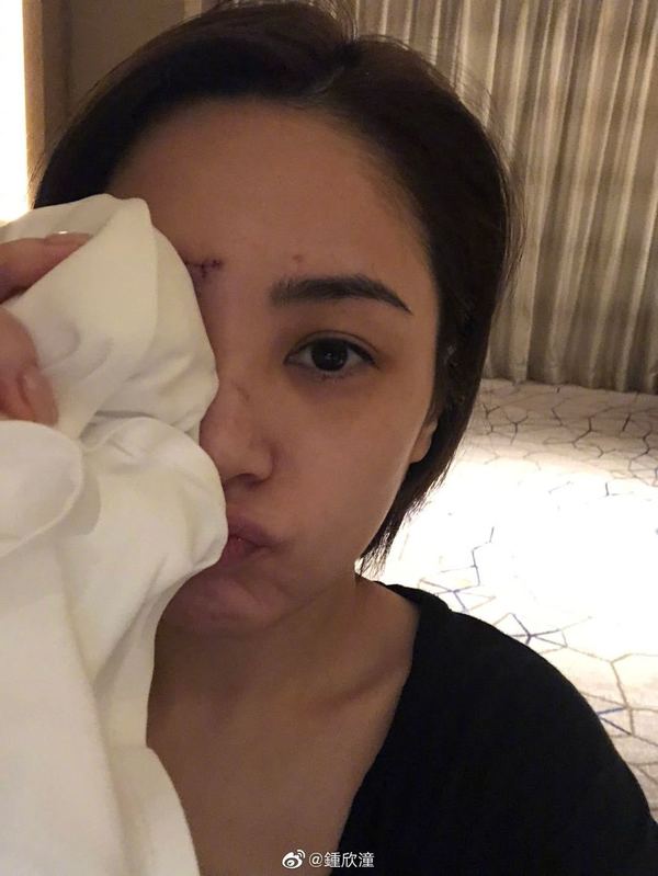 阿嬌受傷。