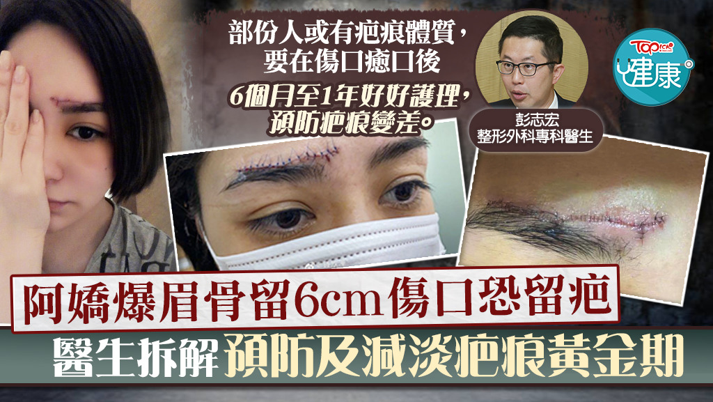 整形外科專科醫生拆解預防及減淡疤痕黃金期。